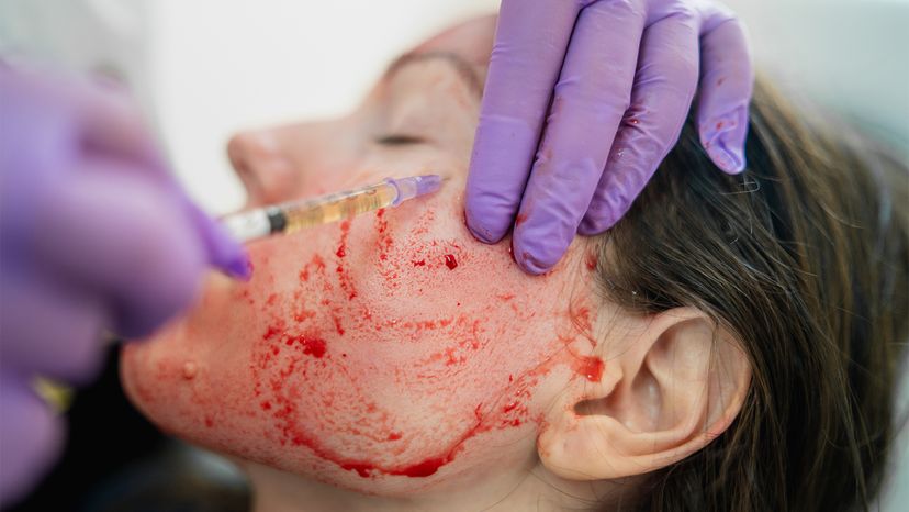 vampire facial, microneedling