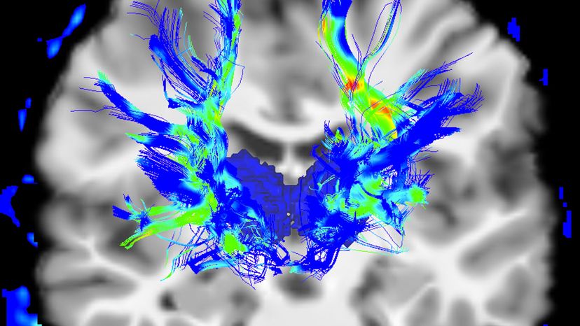 human brain with Parkinson's diseas